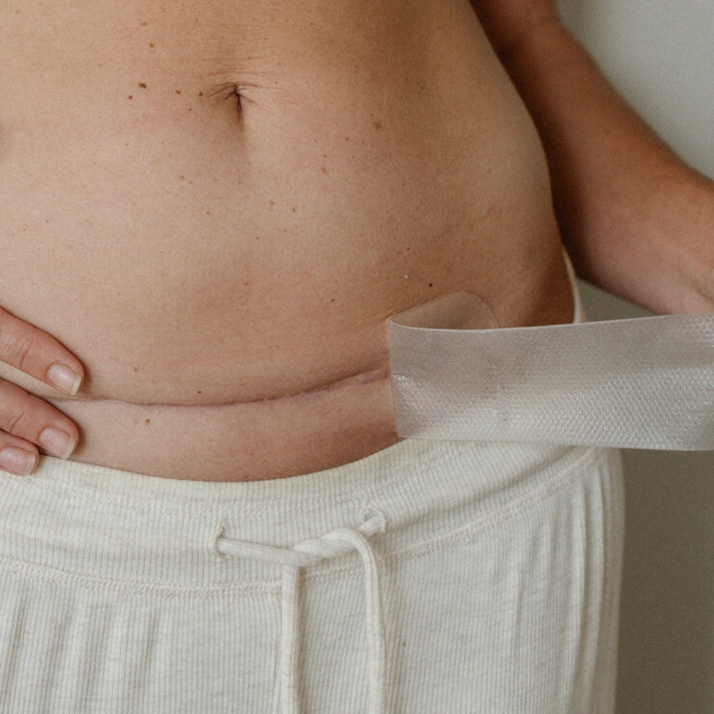 NEW C-Section Scar Care Kit